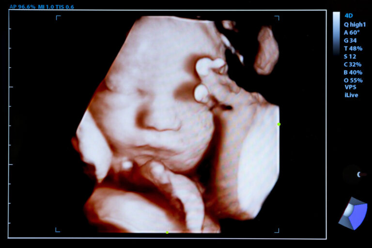 Aborcja